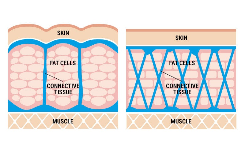 An image comparing two cross-sections of skin. The left side is labeled WOMAN and shows oblong fat cells bulging between straight vertical lines of fascia with a layer labeled MUSCLE on the bottom, while the right side, labeled MAN, shows fascia in an X pattern and fat cells stacked like bricks with flat skin on top and muscle on the bottom.